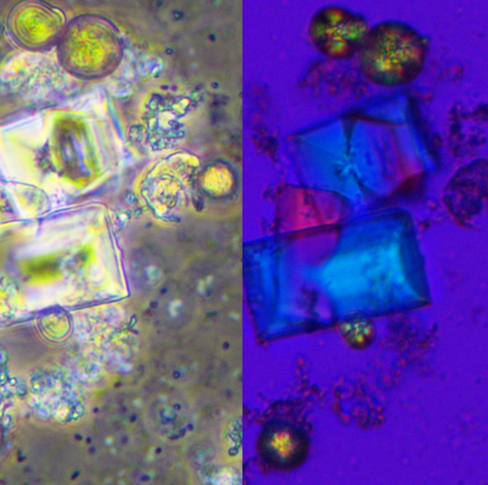 Bacteriuria acompañada por cristales de fosfato amónico magnésico (estruvita) y urato monoamónico