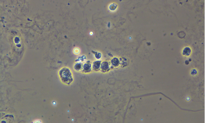 Cilindro epitelial (células tubulares) en paciente con Lupus Eritematoso Sistémico (LES)